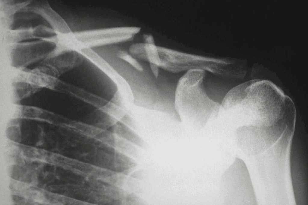 Spinal Bone Fracture Treatment: 7 Key Strategies