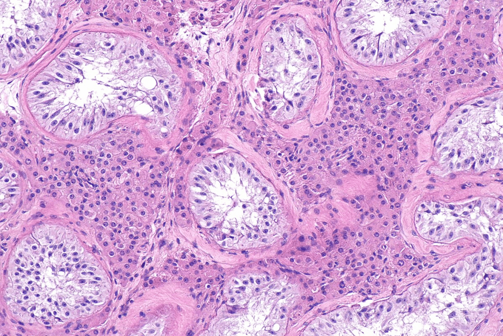 Enlarged Prostate Cure: Can Medications Like Flomax Help?