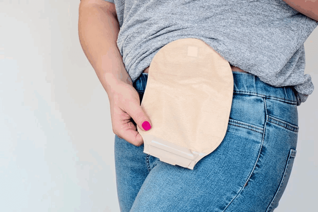 Colostomy Bag Poop: What It Is & Why Needed 2 Colostomy Bag Poop: What It Is & Why Needed