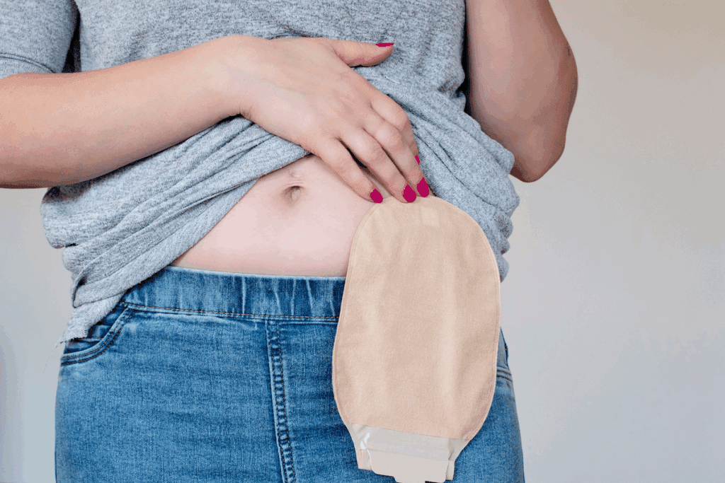 What Does a Colostomy Bag Look Like? Guide