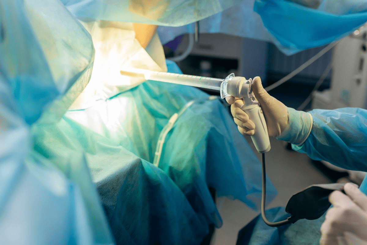 Anal Fistula Surgery: 7 Key Facts