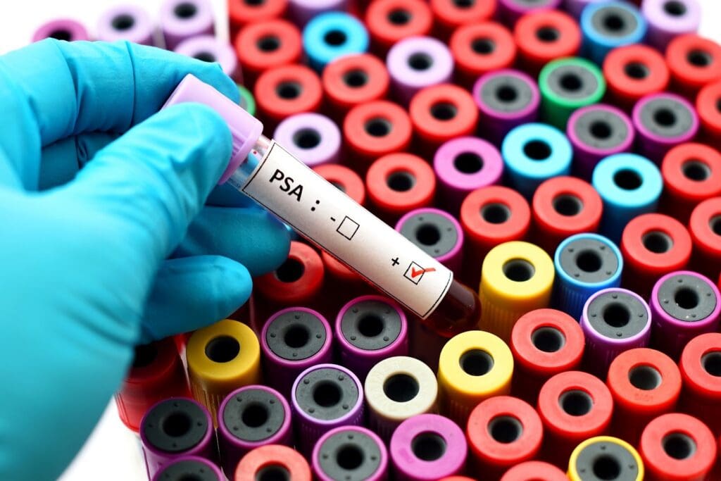 Does Arousal Increase PSA? | Prostate Arousal Facts