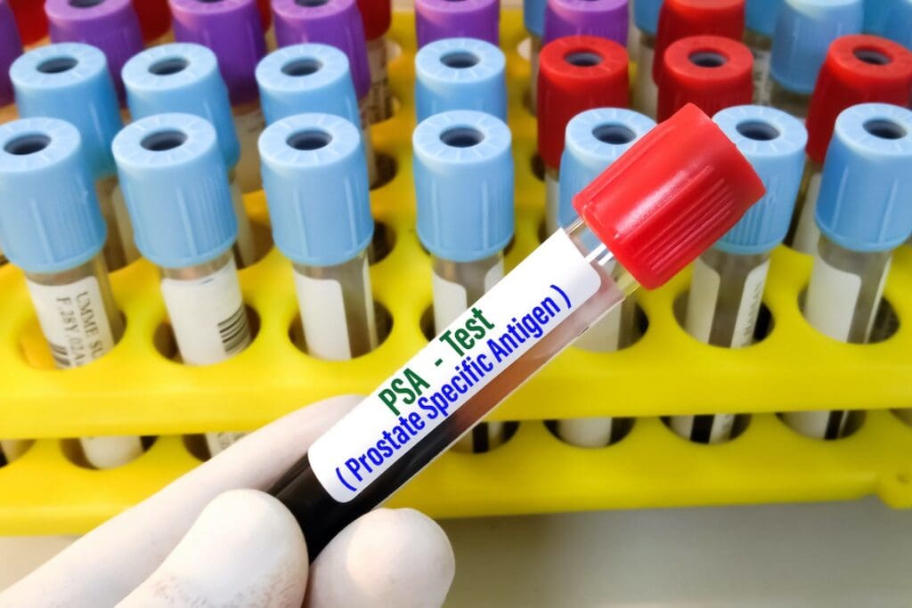 Does Alcohol Affect PSA Test Levels?