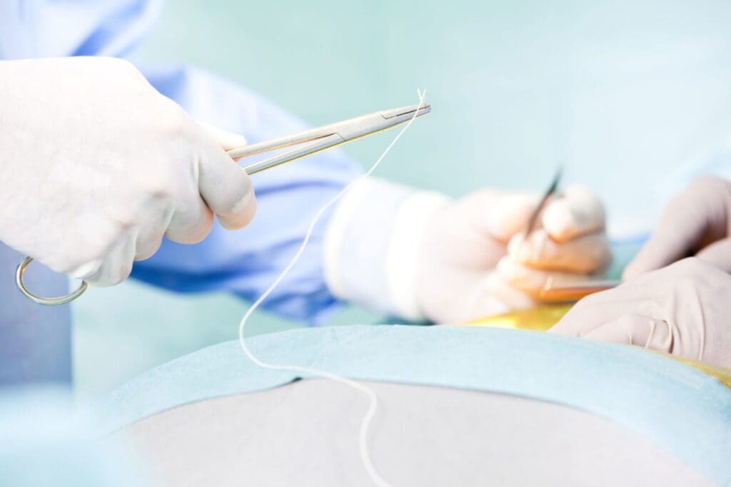 Bed Rest Post-Hernia Surgery: Recovery From Hernia Surgery With Mesh