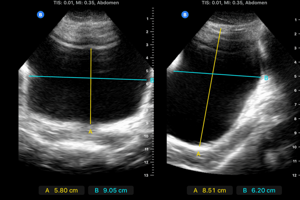 Abnormal PVR: What the PVR Medical Abbreviation Means