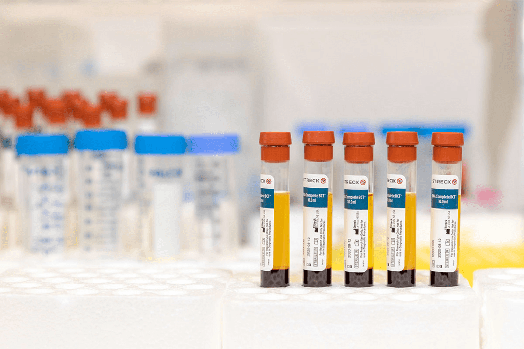 What Makes a Bad Urinalysis Result? Leukocyte Esterase