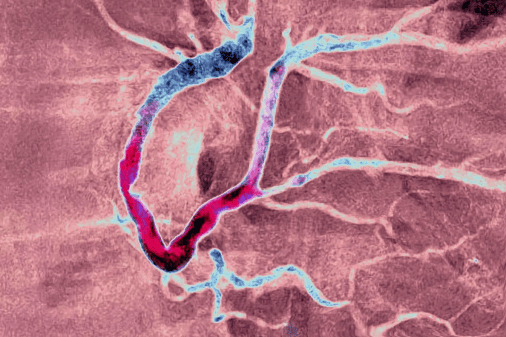 How to Know if You Have Plaque in Your Arteries