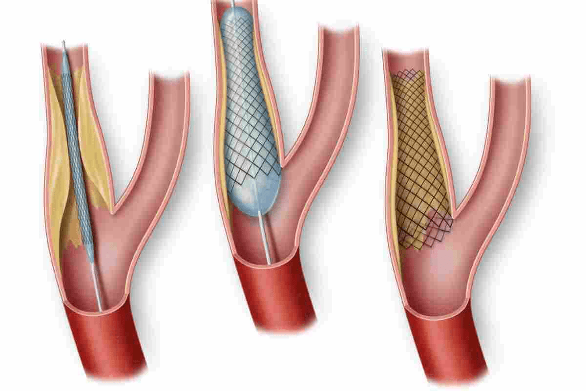 How Big Is a Coronary Stent? Heart Facts