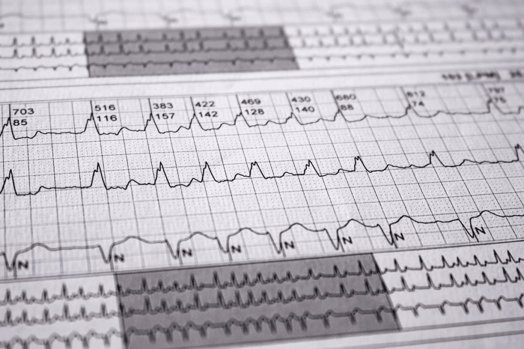 Cardiac Arrhythmias ECG: 5 Essential Detection Tools