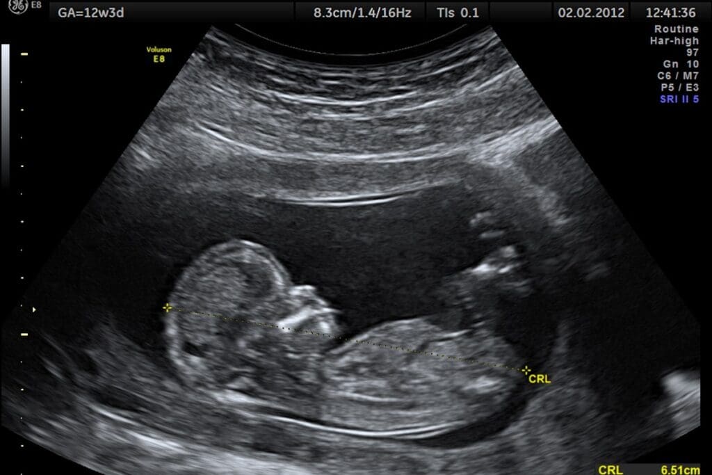 Bad News at 20 Week Ultrasound: How Common Is It?