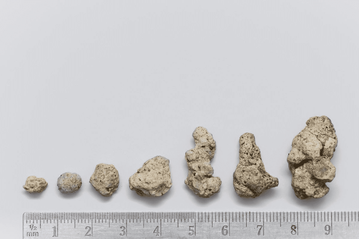Identifying the Top 5 Kidney Stone Symptoms for a 5mm Stone