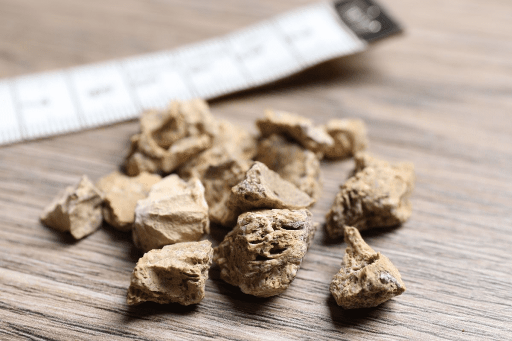 Why Calcium Phosphate Kidney Stones are ESWL's Hardest Challenge