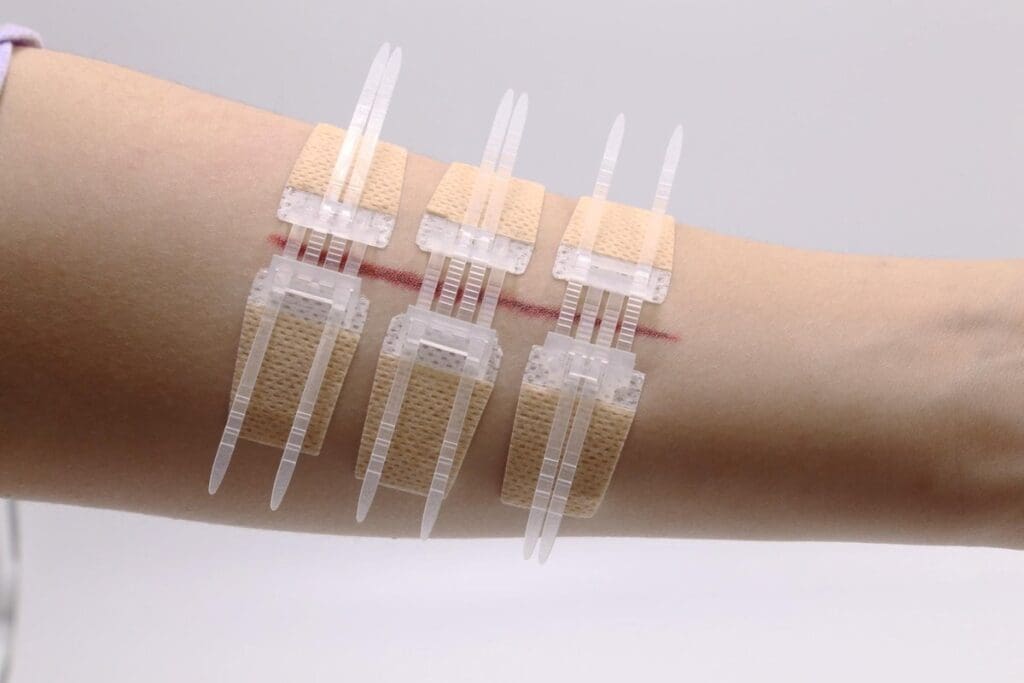 Dissolvable Stitches: The Ultimate Care Secrets 1 Dissolvable Stitches: The Ultimate Care Secrets