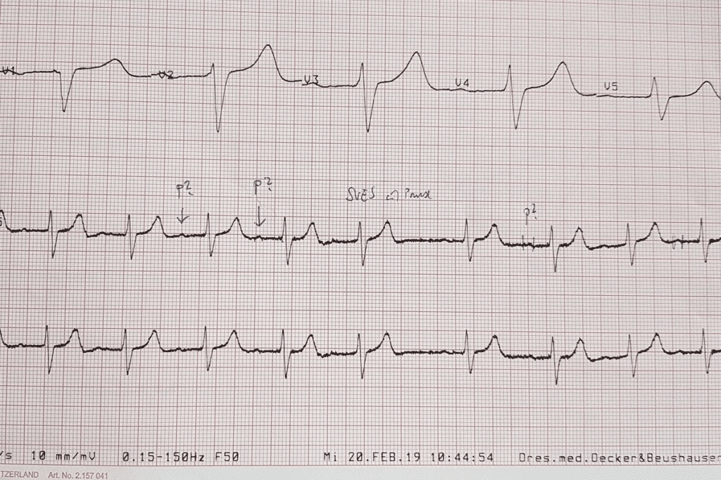 Third Heart Block ECG: 7 Key Features