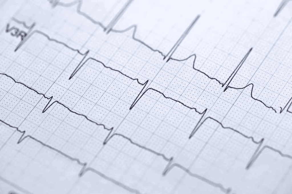 3rd Degree AV Block ECG: Findings