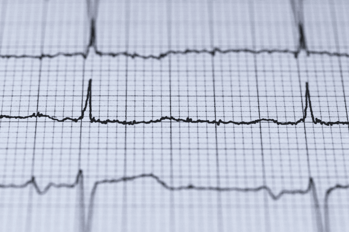Complete Block ECG: 7 Key Findings