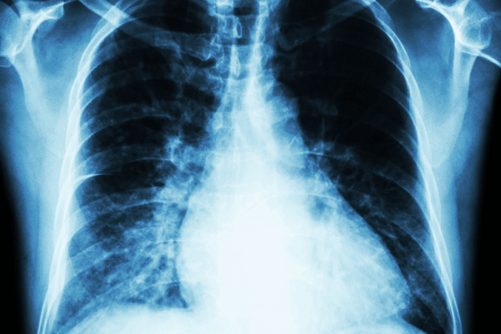 Mild Cardiomegaly: Causes and Treatments