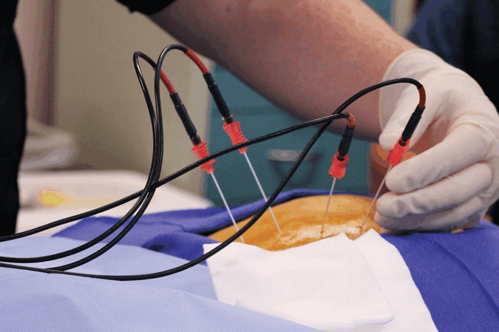Radiofrequency Ablation Surgery: 7 Key Facts About Heart Arrhythmia Treatment 3 Radiofrequency Ablation Surgery: 7 Key Facts About Heart Arrhythmia Treatment