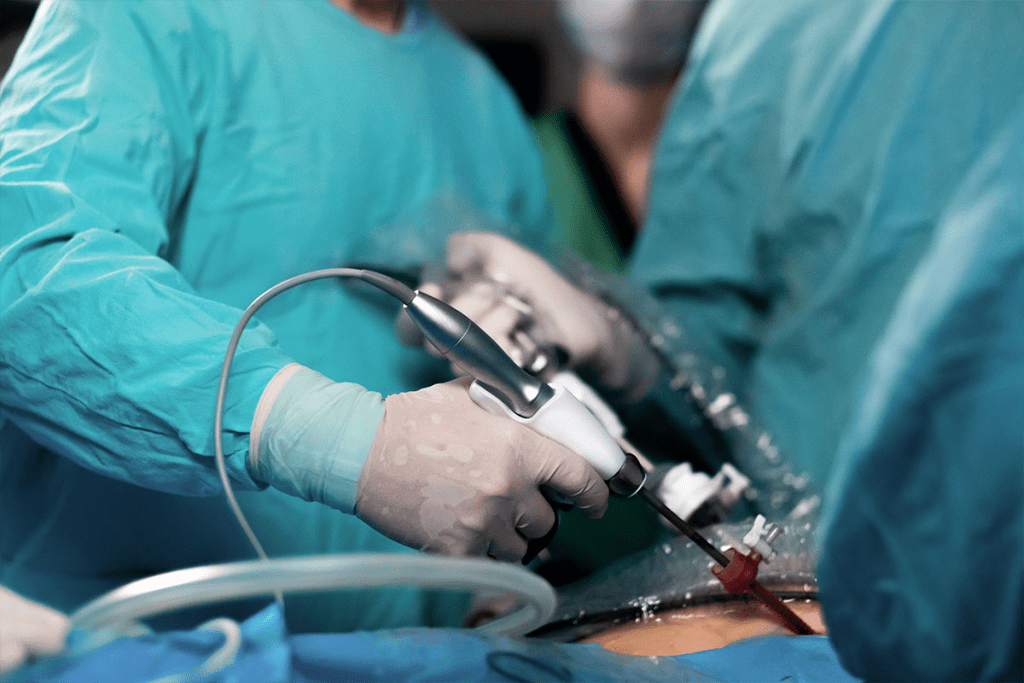 Operate Prostate: Downsides of TURP Surgery