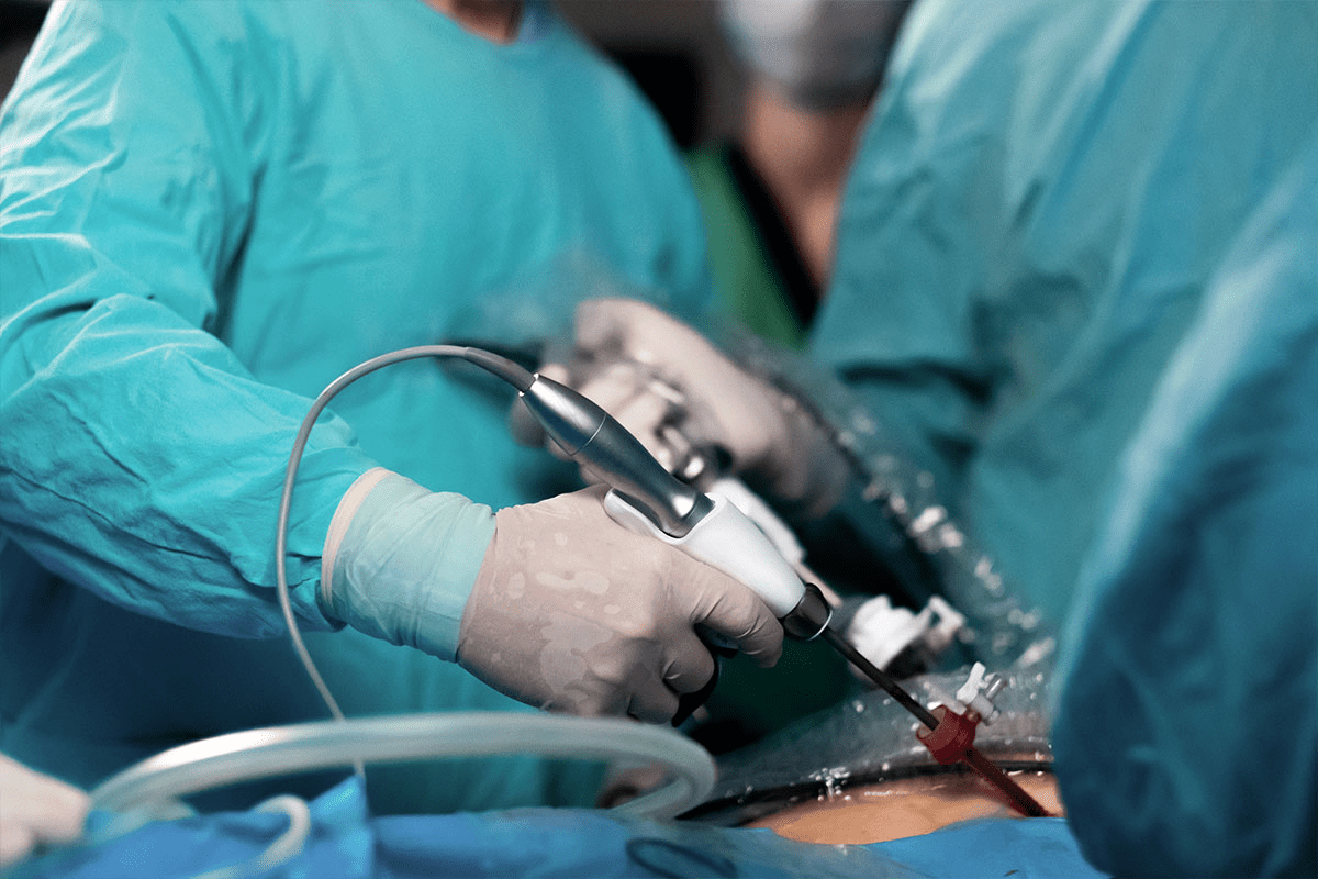 Operate Prostate: Downsides of TURP Surgery