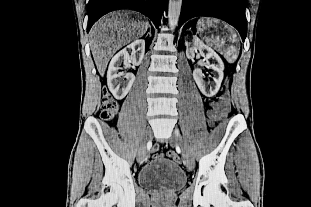 Definitive Answer: What Does a ct urogram Test For?