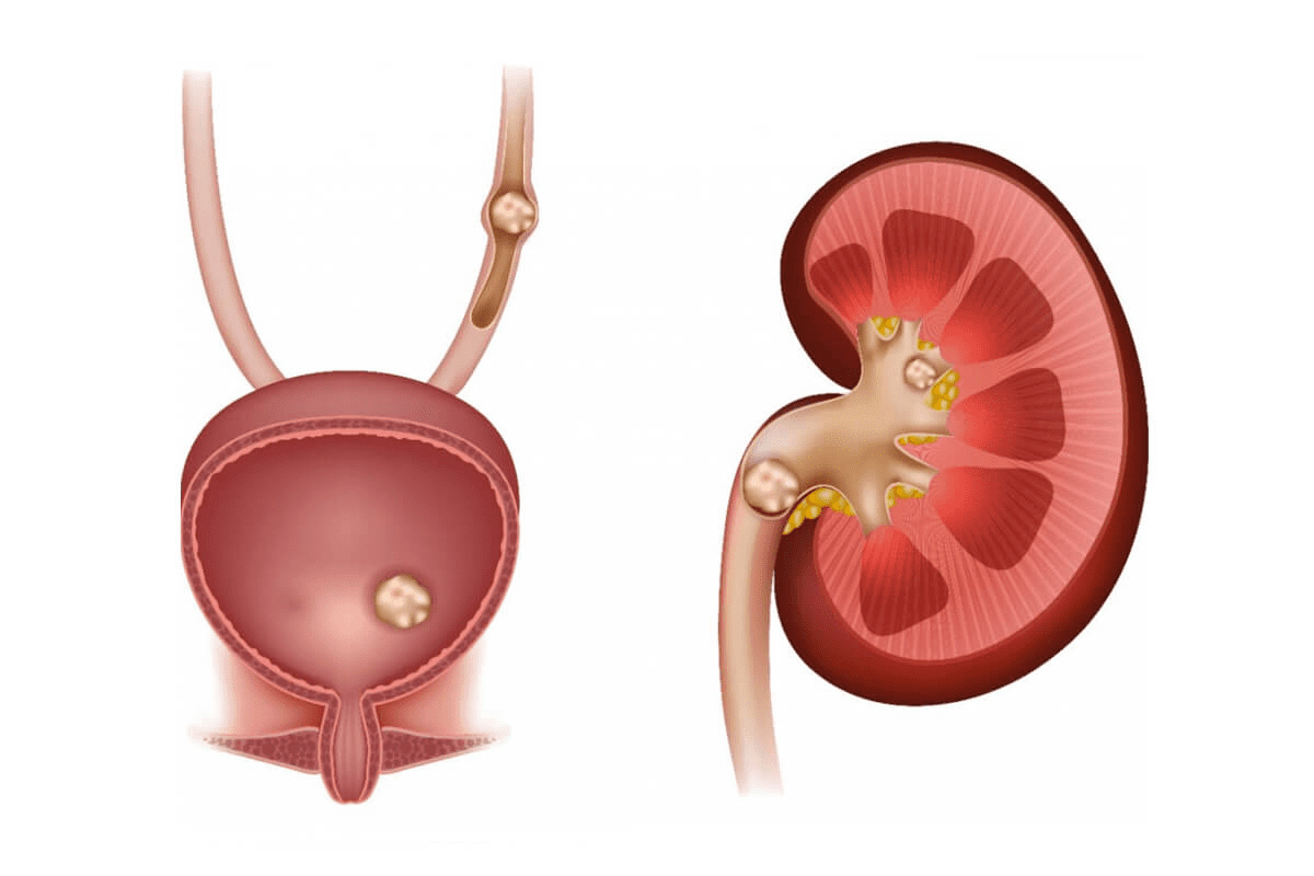 Largest Kidney Stone Passed Naturally: What You Need to Know