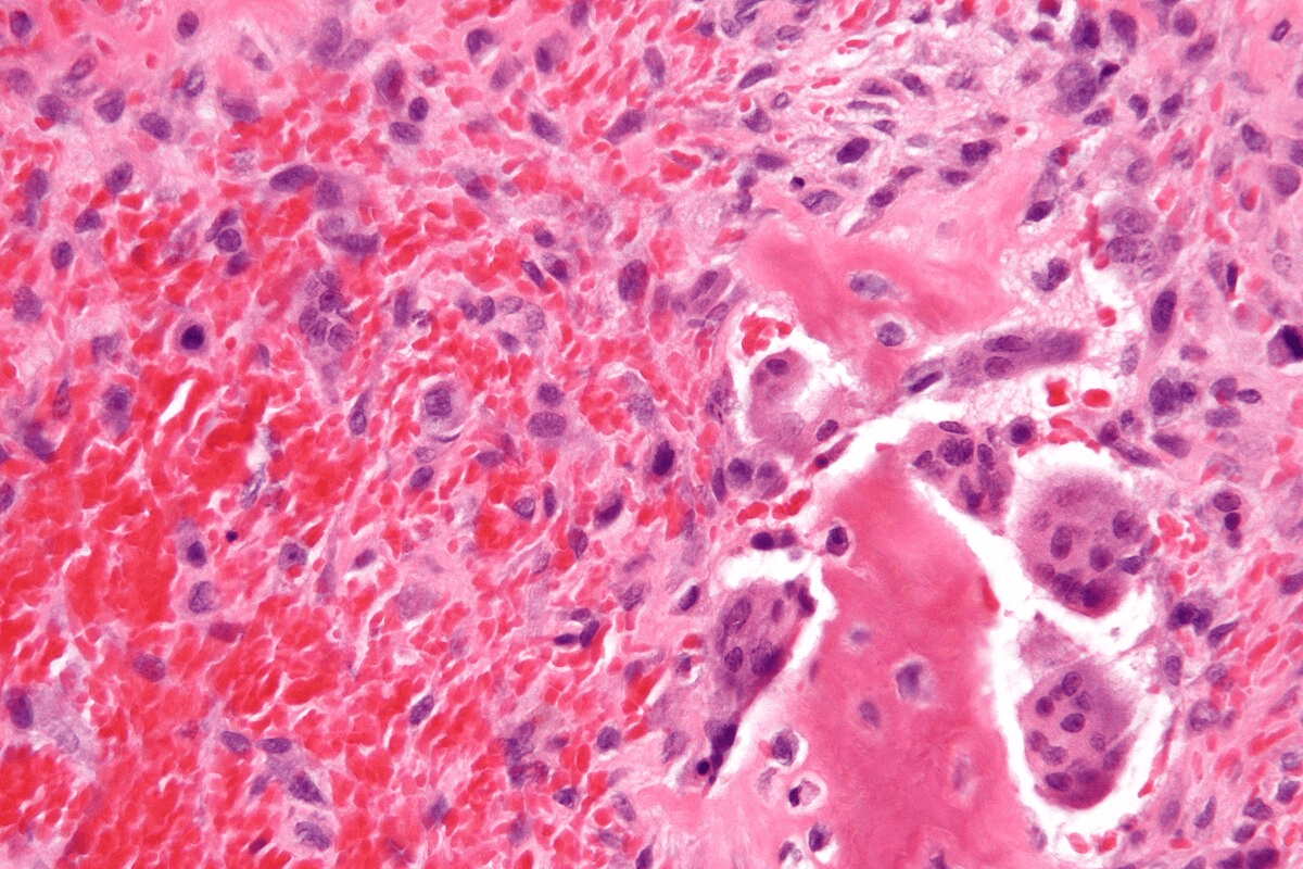 Chemo Drugs for Bladder Cancer: 5 Key Treatment Options