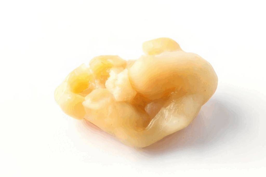 Quinsy Throat: Powerful Causes, Signs & Treatment