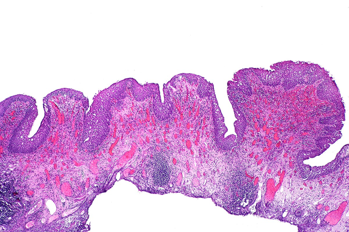 Stage 3 Bladder Cancer Prognosis: What to Expect