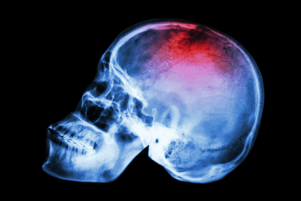 Skull Cancer: Causes, Symptoms & Treatment