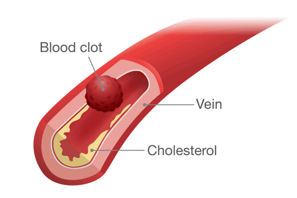 UTI and Blood Clots: Causes and When to Worry 1 UTI and Blood Clots: Causes and When to Worry
