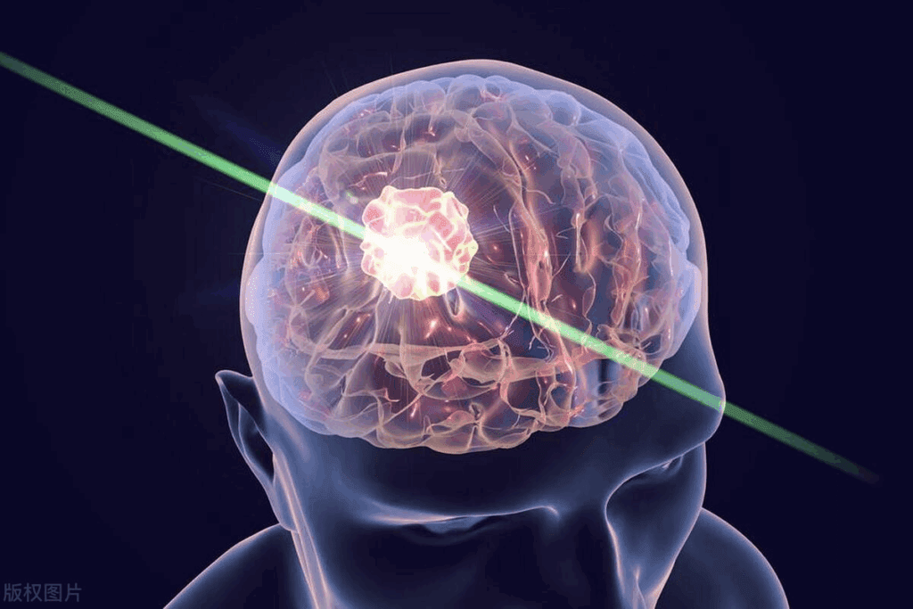 Brain Metastases Symptoms: Early Signsbrain-metastases-symptoms