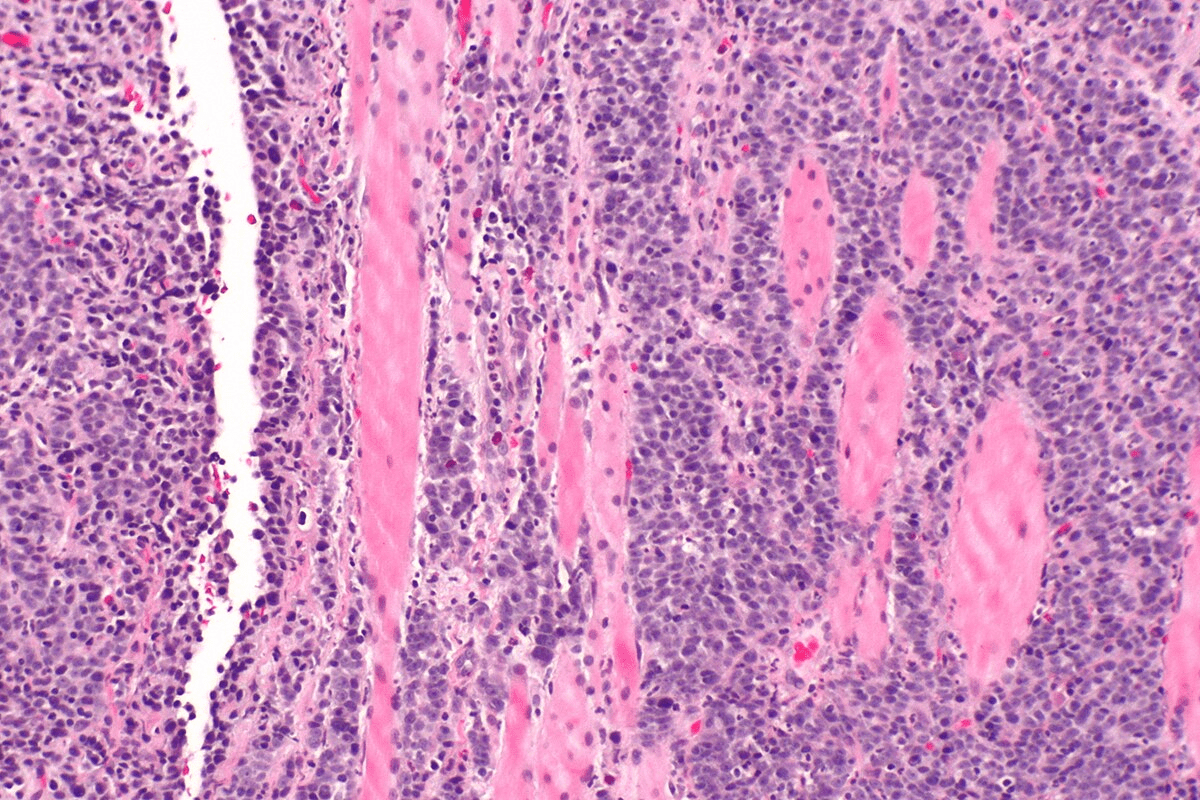 Squamous Cell Skin Cancer on Scalp Facts