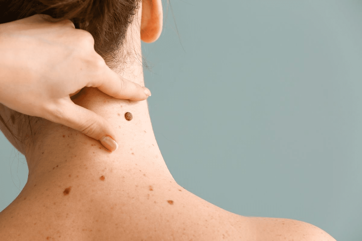 Cancerous Moles on Scalp: What to Know