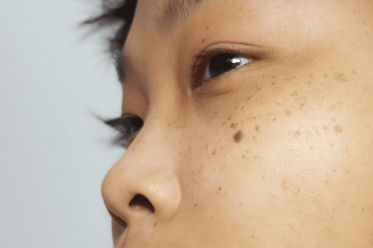 Skin Cancer on Head: Early Signs