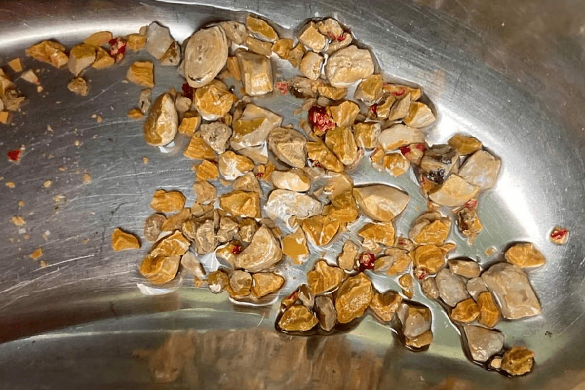 Can Kidney Stones Be Black In Color? How to Know