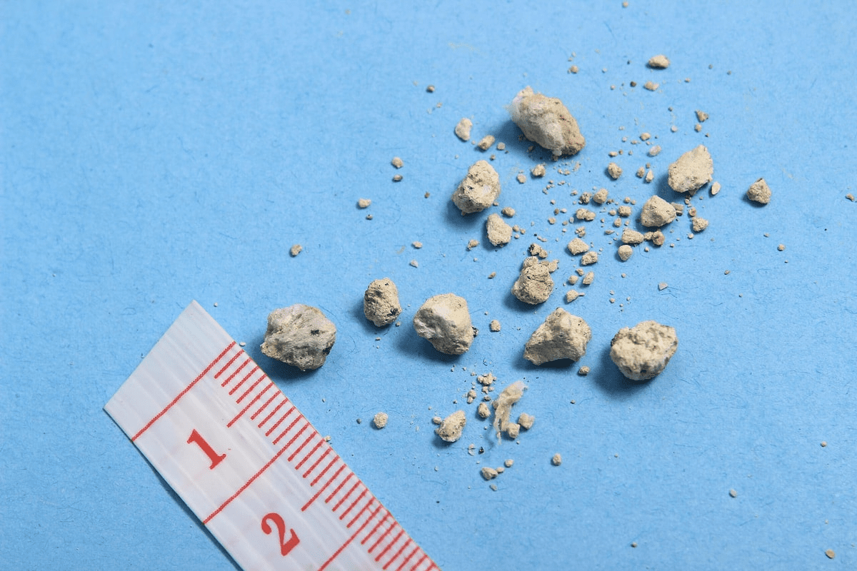 Do Kidney Stones Make Your Urine Smell?