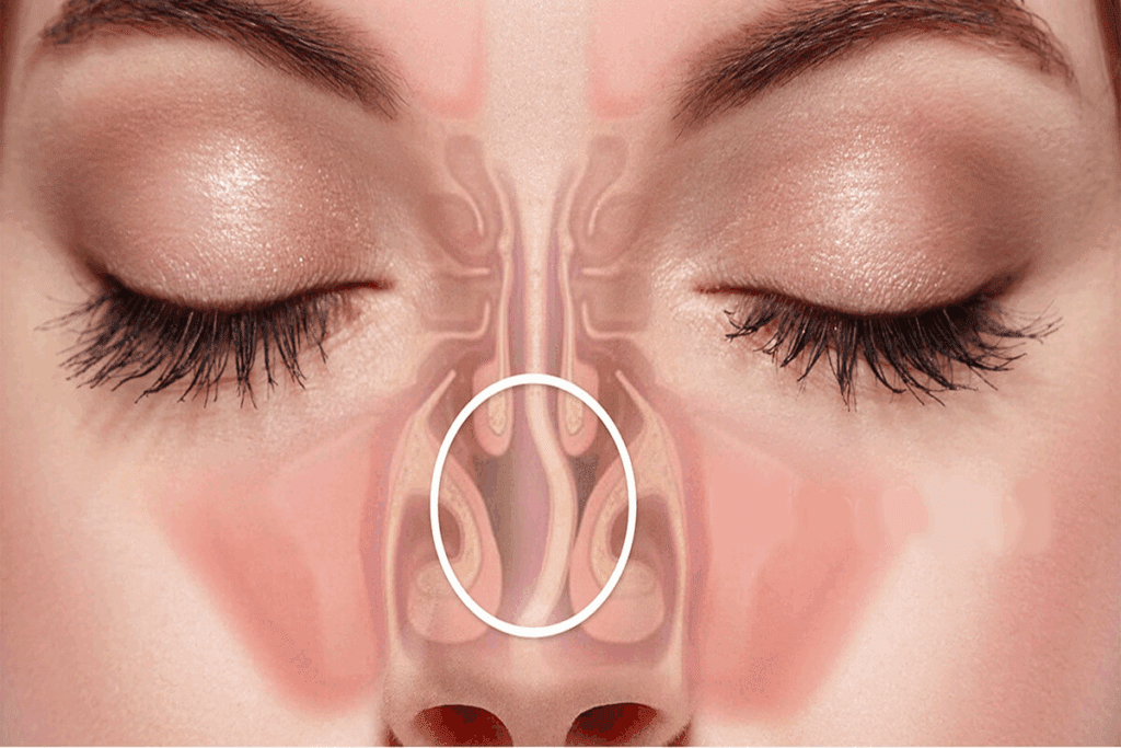 What Is Septoplasty? Definition and Overview