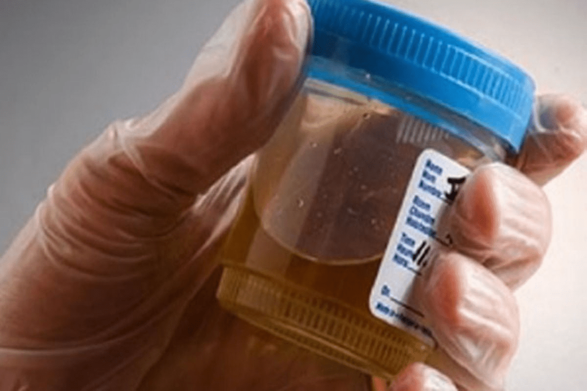 Crystals in Blood Work: Meaning & Causes