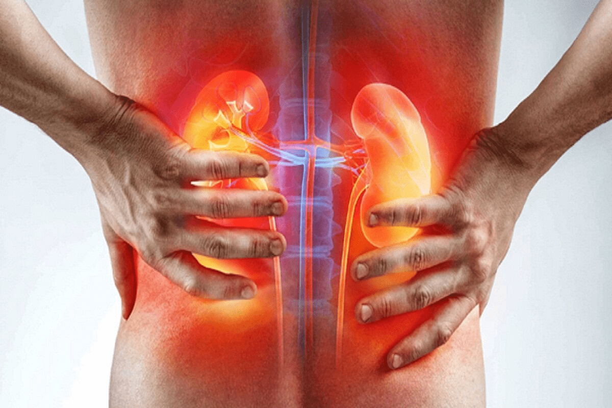 Kidney Stones Bloating Explained