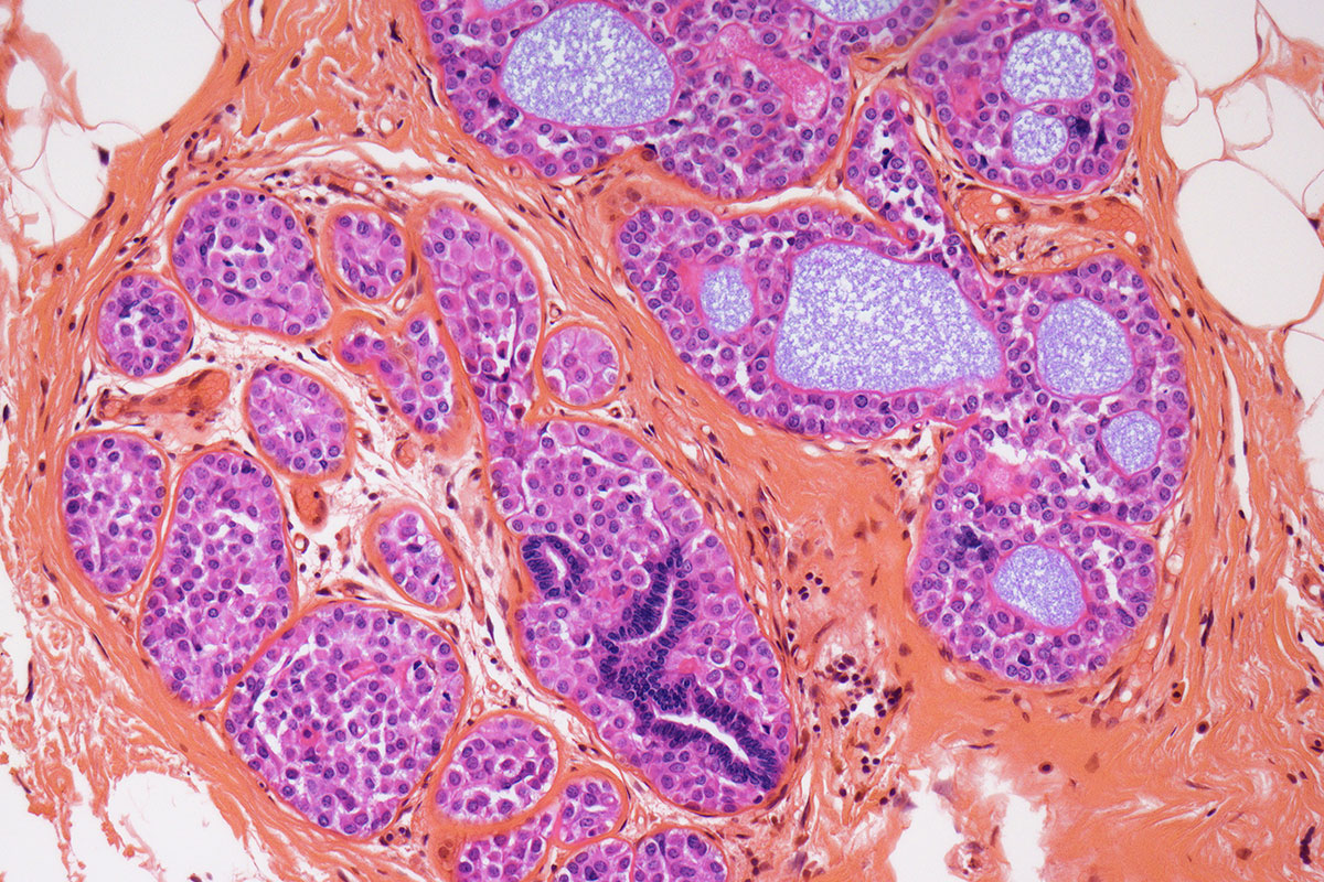 Carcinoma Situ Meaning and Definition