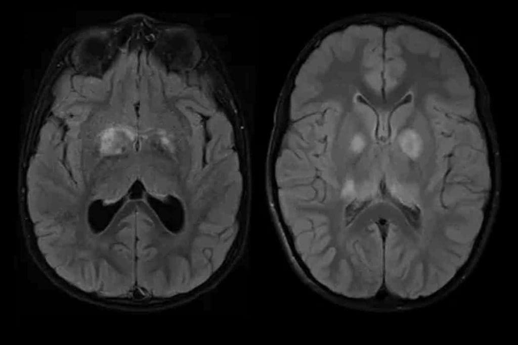 Would a PET Scan Show Bone Cancer? Facts You Need