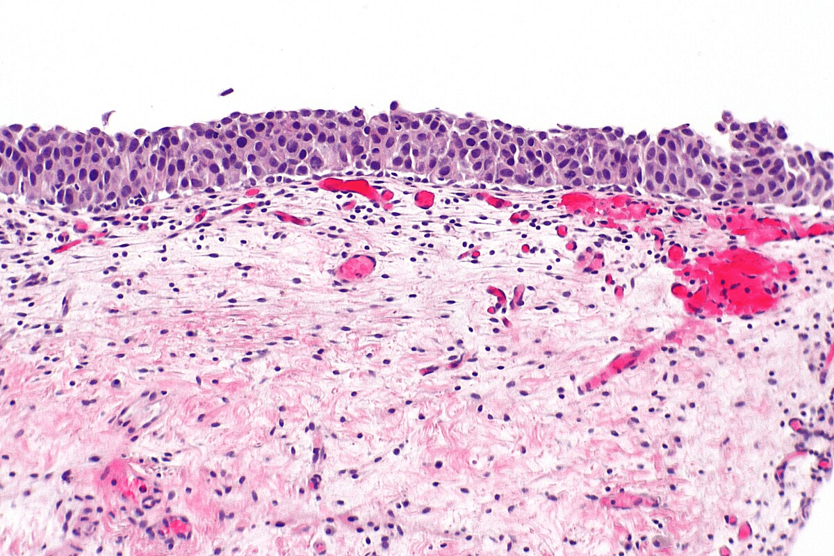 Define In Situ Cancer: Key Differences