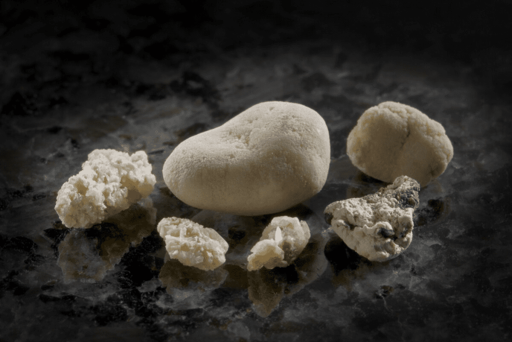 Uric Acid Kidney Stones: Your Ultimate Survival Guide