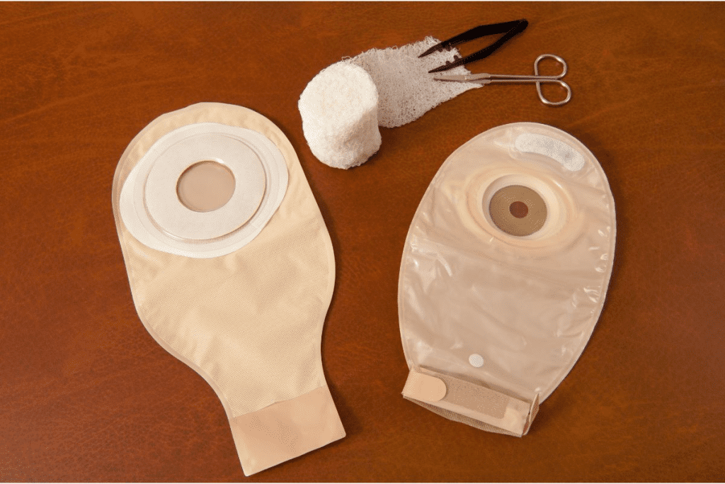 Ileostomy Vs Colostomy: Crucial Surgery Healing Timeline