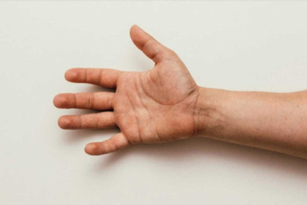 11 Blood Clot in Hand Pictures and Key Symptoms to Watch For