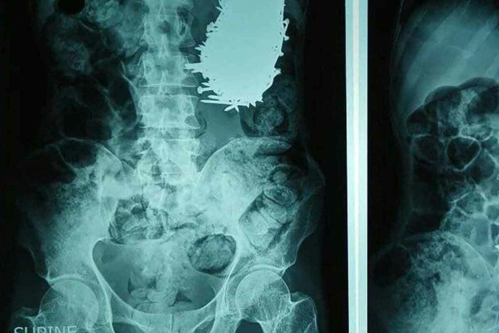 Can You Have Metal in a CT Scan? Crucial Facts Revealed