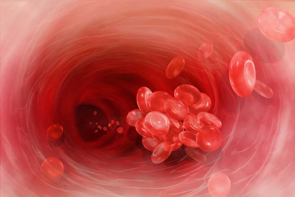 What Is Thrombosis? Definition, Blood Clot Causes, and Key Symptoms Explained