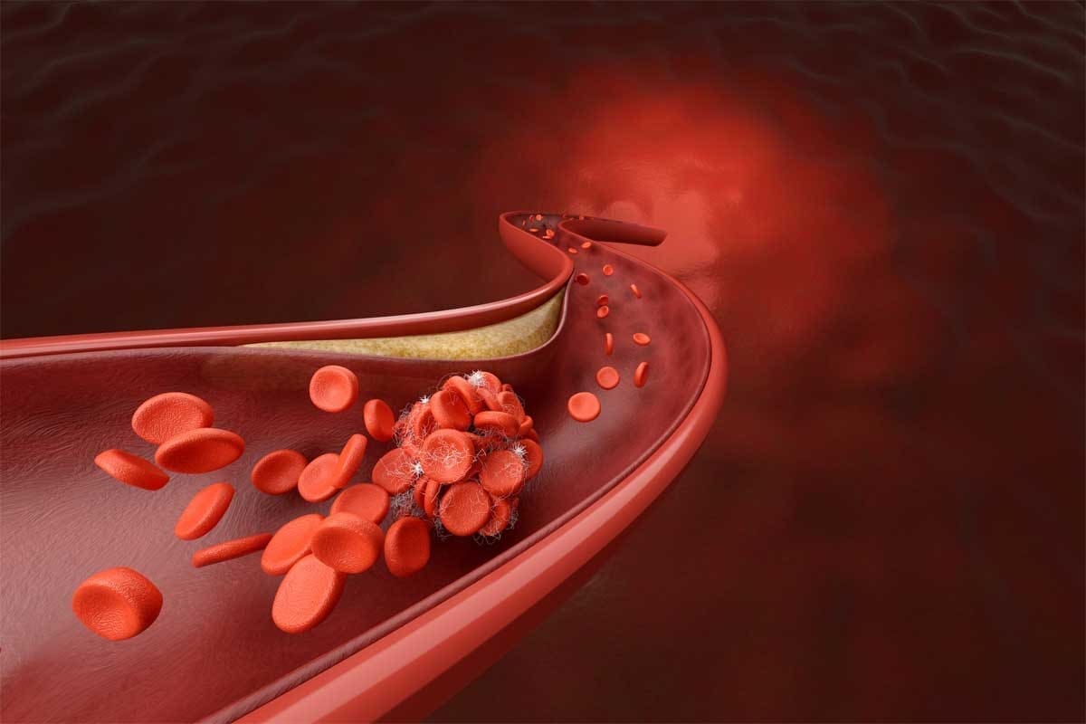 What Is Thrombosis? Meaning, Causes, Symptoms, and Key Definitions