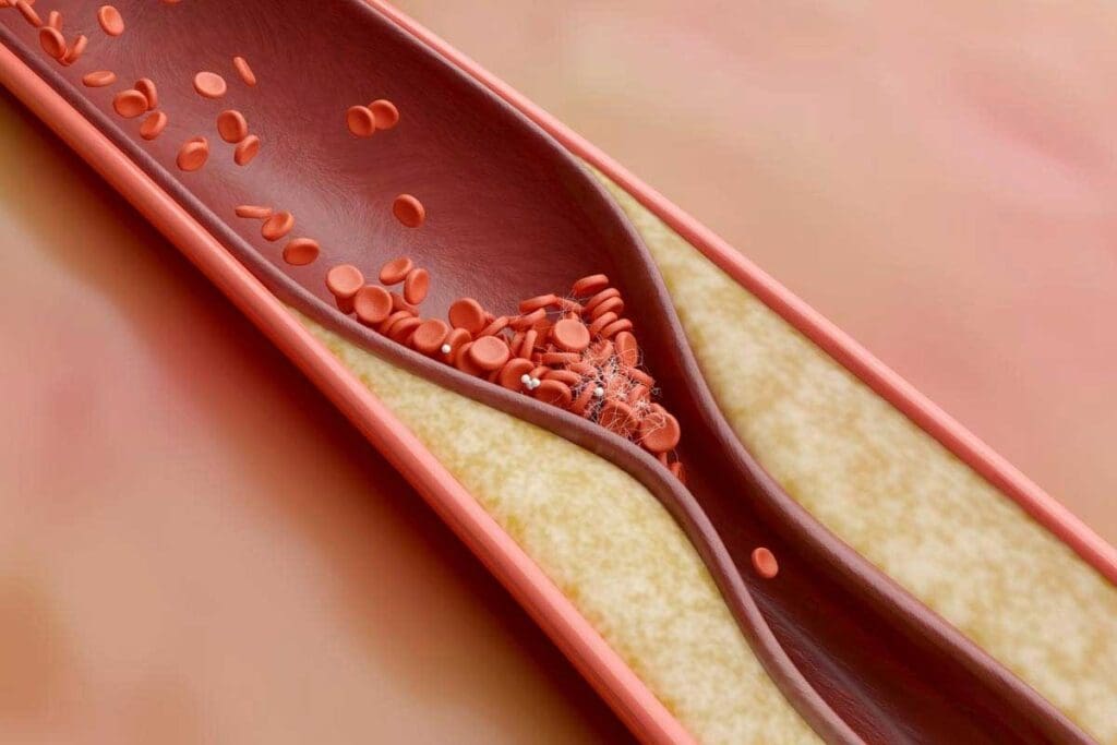 What Is Thrombosis? Thrombosis Meaning, Causes, Symptoms, and Key Definitions 2 What Is Thrombosis? Meaning, Causes, Symptoms, and Key Definitions